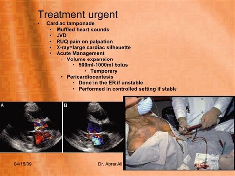 Uremic Pericarditis