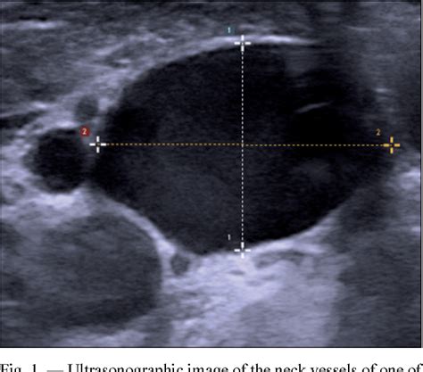 [PDF] Internal jugular vein location and anatomy on ultrasound | Semantic Scholar