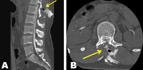 Lumbar Spine: Ct Myelogram Lumbar Spine