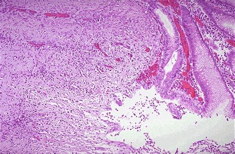 Pathology Outlines - Acute gastric ulcer