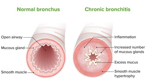 Bronchitis: Causes, Symptoms, Diagnosis & Prevention