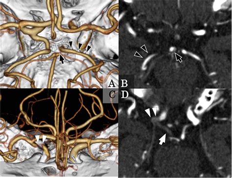 Pure posterior communicating artery occlusion treated with mechanical ...