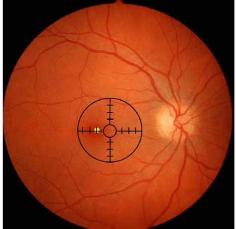 Evaluation of Monocular Fixation (Visuoscopy, Haidinger Brush, Brock ...