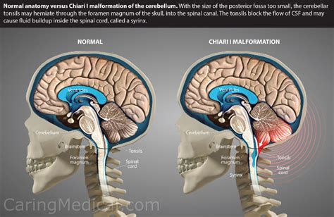 Cerebellar tonsillar ectopia herniation and Chiari 1 malformation: Non ...