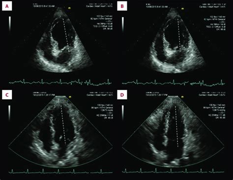 Transthoracic echocardiogram (apical 4-chamber view) showing apical and ...