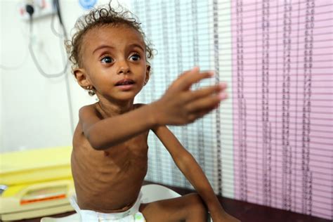 UNICEF: Millions of Yemeni children in immediate risk of starvation | Al-Thawra Net