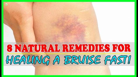 How To Get Rid Of Bruises Fast And Naturally? - Bruise Treatment | Best ...