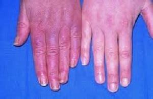 What Is Acrocyanosis? - Definition, Causes & Symptoms | Study.com