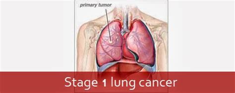 Stage 1 lung cancer | Stage 4 Lung Cancer