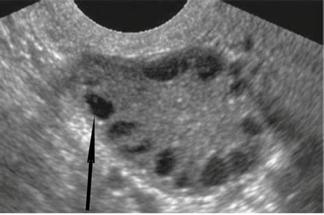 Cureus | Polycystic Ovary Syndrome Among Female Adolescents With ...