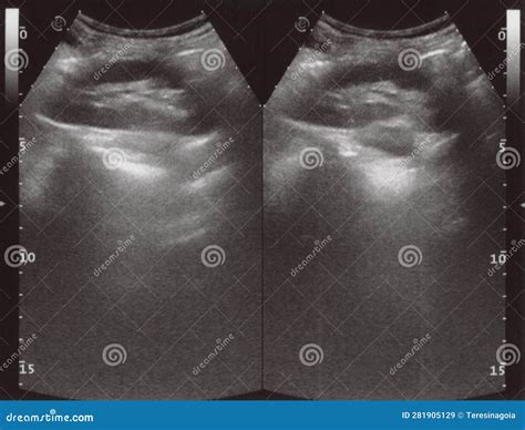 Full Abdomen Ultrasound Sonogram Stock Image - Image of echography, medical: 281905129