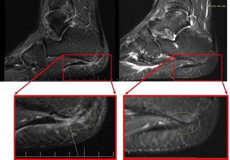 Plantar Fascia Tear