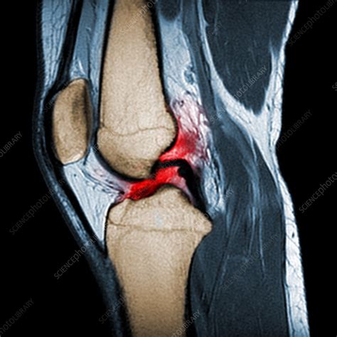 Torn ACL, MRI - Stock Image - C030/5928 - Science Photo Library