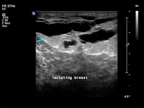 Atlas of breast cancer early detection