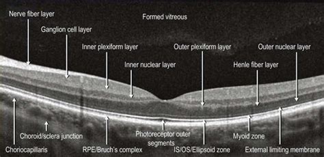 Normal Retinal Anatomy and Basic Pathologic Appearances | Ento Key