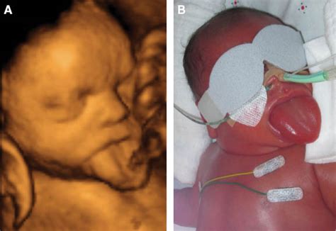 Three-dimensional ultrasound of massive macroglossia in a fetus with ...