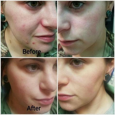 Before and after Dermaplaning with Raechel! Before: uneven, irritated ...