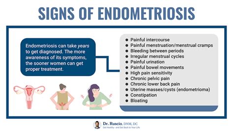 Bowel Endometriosis Symptoms: A Natural Treatment Guide