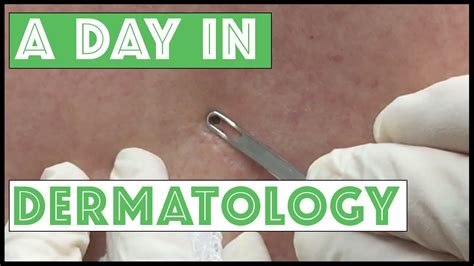 A Day in Dermatology: Various dermatologic procedures including ...