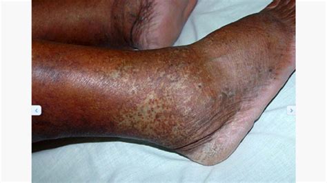 Multiple Myeloma Rash Pictures: Types, Symptoms, and More