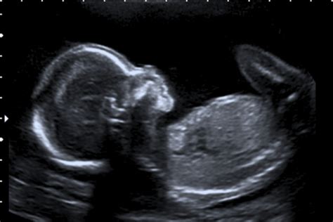 Baby ultrasound pics at 20 weeks Idea | hostalelportalico