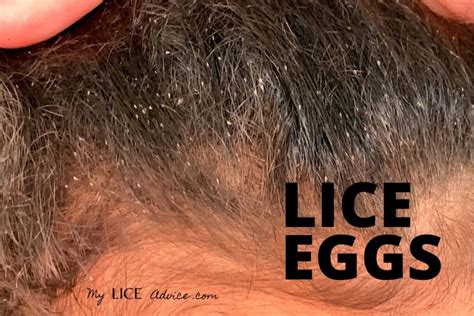 Pictures of What Lice Eggs (Nits) Look Like in Hair: 9 Tips to Spot Them