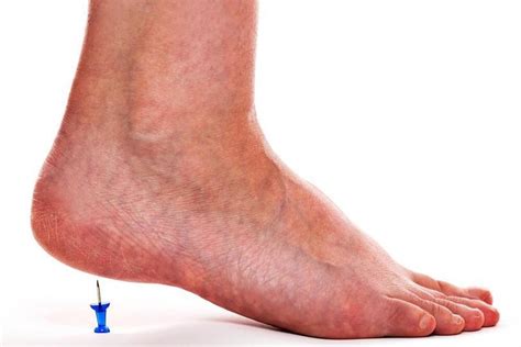 Heel Spur: Causes and Treatment | Women's Alphabet