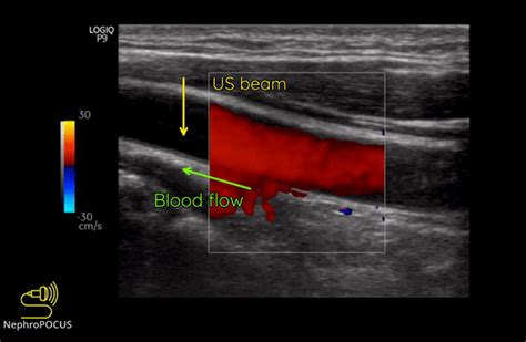 Basics of Doppler Ultrasound for the Nephrologist: Part 1 - Renal Fellow Network