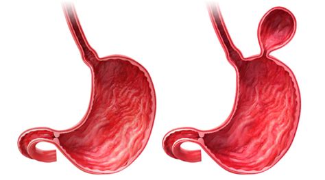 Método de la cirugía para la hernia de hiato - Portal Salud