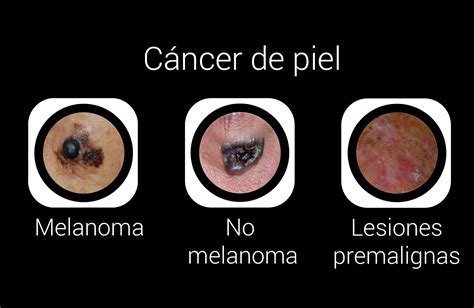 Cáncer de piel - Lidia Pérez dermatólogos