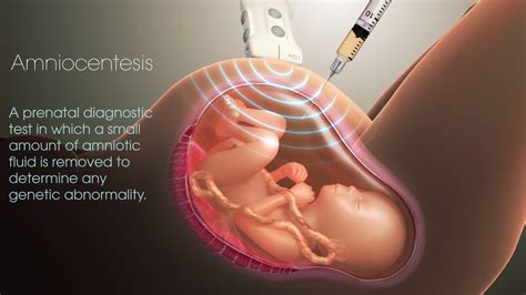 Amniocentesis Risks