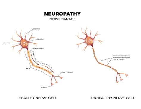 Neuropathic Pain/Peripheral Neuropathy Pain - The Orthopedic Pain ...