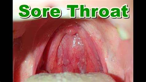 Normal Healthy Throat Pictures