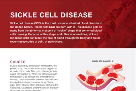 Sickle Cell Disease - What Is Sickle Cell Disease? | NHLBI, NIH