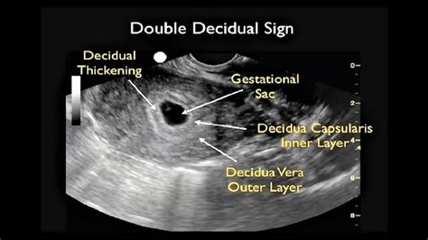 What Is Intrauterine Pregnancy? Early Intrauterine Pregnancy