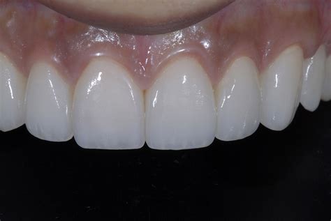 Interdental Papilla Reconstruction All Options - Advanced Cosmetic Dentistry