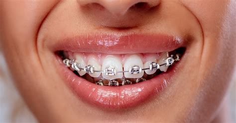 Removable orthodontic appliances: treatment with aligners 🦷