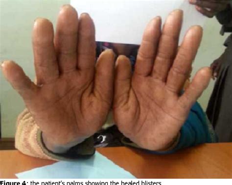 Figure 5 from Palmar-plantar erythrodysesthesia associated with ...