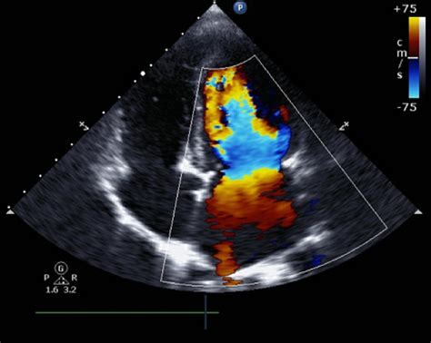 WHAT ARE THE DIFFERENT TYPES OF HEART ULTRASOUNDS?