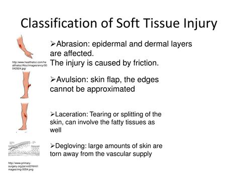 PPT - Soft Tissue Injury PowerPoint Presentation, free download - ID:2220459