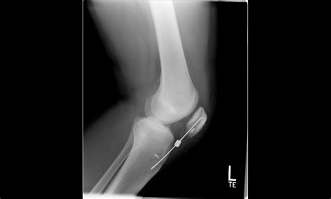 Innovative Treatment for Patellar Tendon Rupture | SHELBOURNE KNEE CENTER