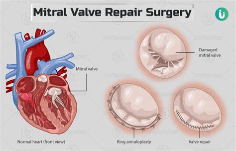 Mitral valve repair surgery: Procedure, Purpose, Results, Cost, Price