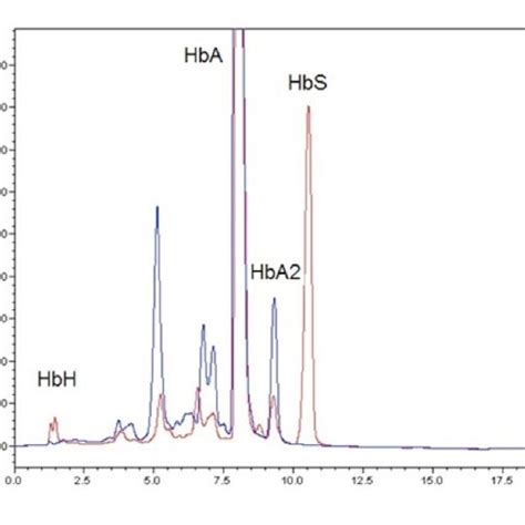 Hemoglobin analysis of Hb H-Hb CS patient showing Hb Bart's, Hb H, Hb ...