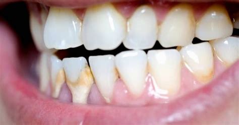 8 Easy Methods For Dental Calculus Removal At Home! Guide 2024