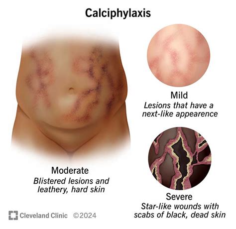 Calciphylaxis: Symptoms & Causes