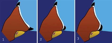 Schema of the posterior glenoid rim variants. 1. Normal triangular. 2.... | Download Scientific ...