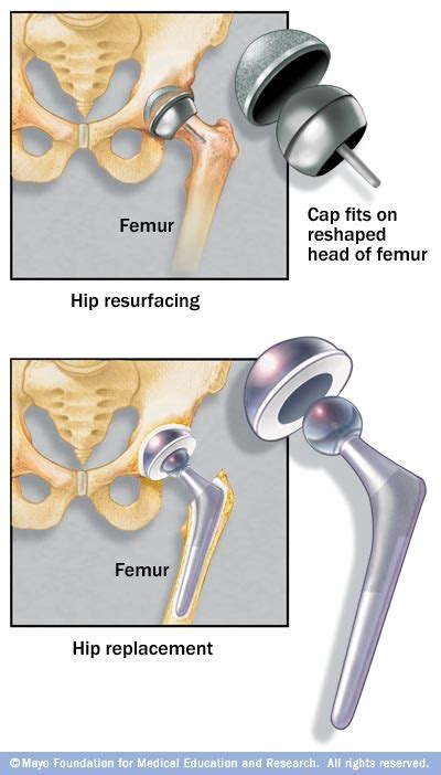 Hip resurfacing - Mayo Clinic