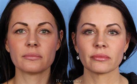 Lower Eyelid Blepharoplasty Photos • Rejuvent Medical Spa Scottsdale