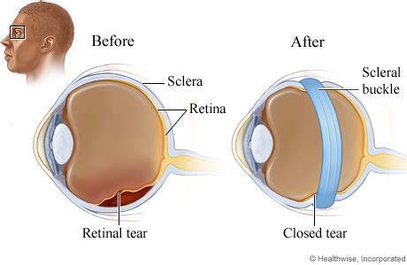 Scleral Buckling Surgery for Retinal Detachment Surgery Information