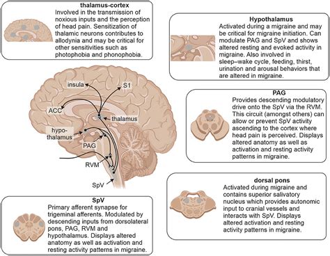 Migraine Headache Diagram